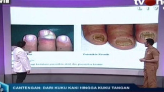 Cara Mengobati Cantengan, Pahami Penyebab dan Gejalanya
