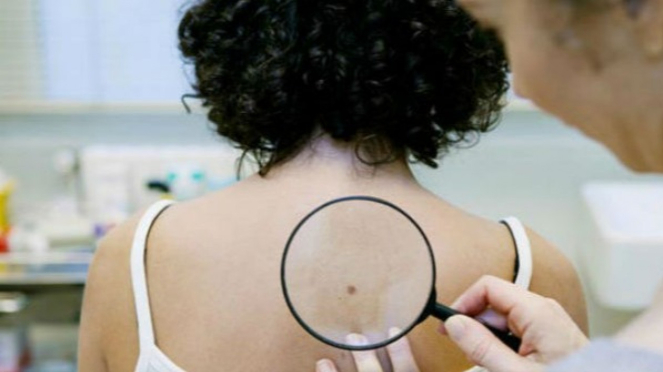 Ilustrasi kanker kulit.
