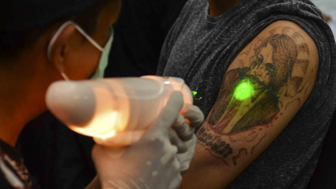 Menghapus tato dengan laser di Tasikmalaya