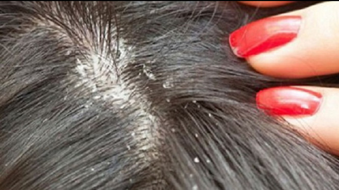 Empat Mitos Kutu Rambut Yang Sering Dianggap Fakta