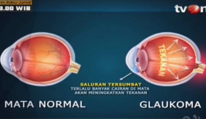 Ayo Hidup Sehat - Glaukoma