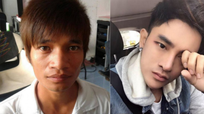 Pria Thailand sebelum dan setelah operasi plastik