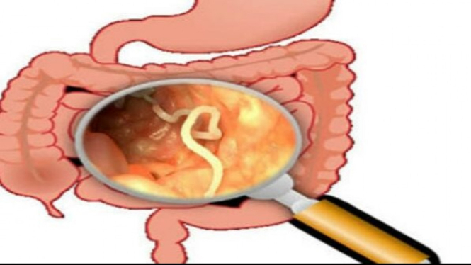 Ilustrasi cacing parasit dalam usus.