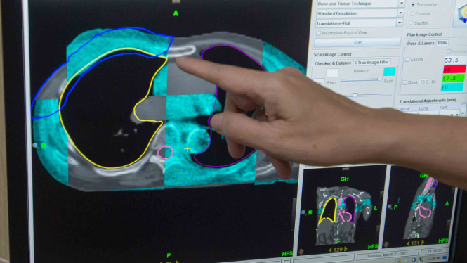 Pengobatan kanker menggunakan alat radioterapi Thomotherapy.