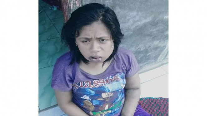 Eliyatul Ikhlas, gadis asal Pandeglang yang menderita penyakit langka