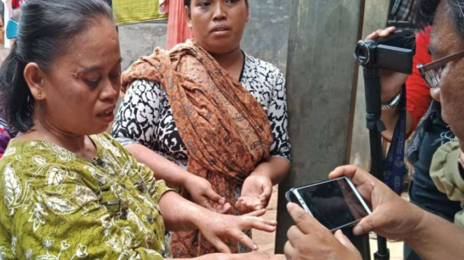 Warga gatal-gatal diduga akibat terpapar air tercemar di Kabupaten Tangerang