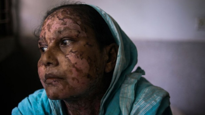 Seorang perempuan pengungsi Rohingya -Ziaul Haque Oisharjh/SOPA Images/LightRocket via