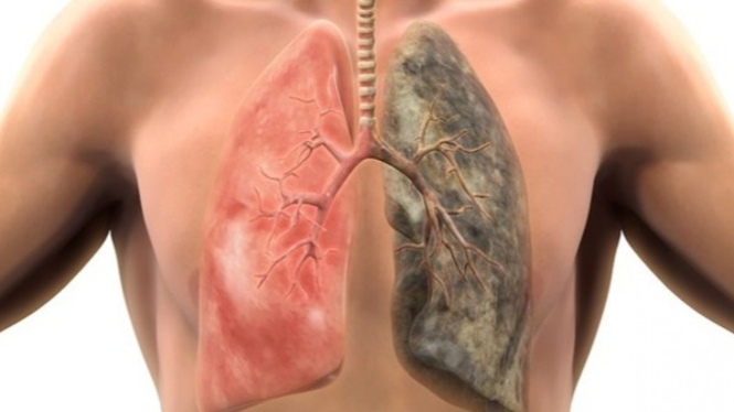 Ilustrasi penyakit TBC.