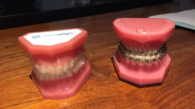 Clear Aligner