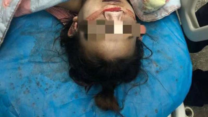 Gadis China yang meninggal usai operasi hidung.