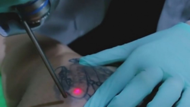 Menghapus tato dengan laser di ZAP Clinic