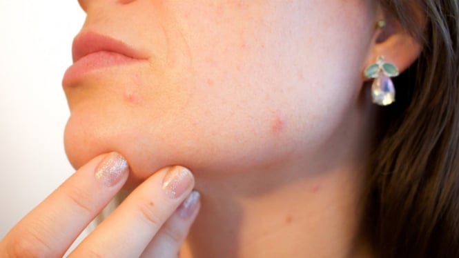 20 Ways to Get Rid of Acne Scars with Natural Ingredients