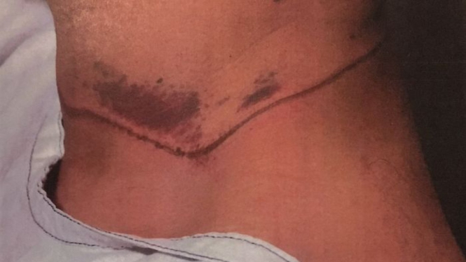Bekas jeratan tali sepatu di leher Abdolhadi Moradi dalam serangan bulan Januari 2018.