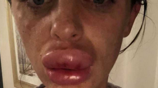 Rachael Knappier saat bibirnya bengkak akibat suntik filler