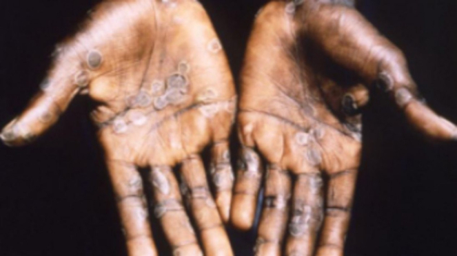 Illustration of a human being infected with monkey pox.