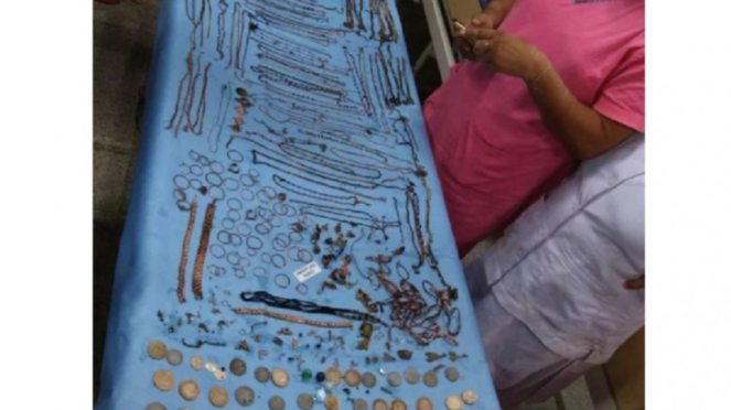 Koin dan perhiasan yang ditemukan di perut pasien wanita di India