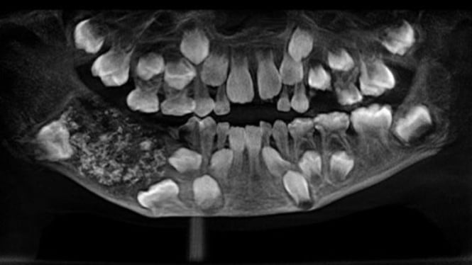 Hasil rontgen menunjukkan kantong gigi yang berisi ratusan gigi di gusi bawah bocah berusia 7 tahun.