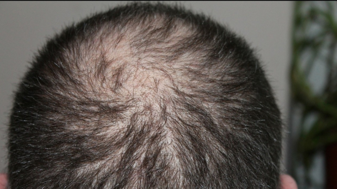 Penyebab Rambut  Rontok pada Pria  Jangan Sampai Botak