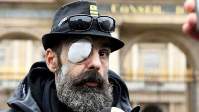 Aktivis demonstrasi dengan mata yang luka. (Getty Images)