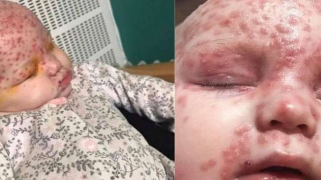 Bayi menderita herpes akibat virus lewat ciuman