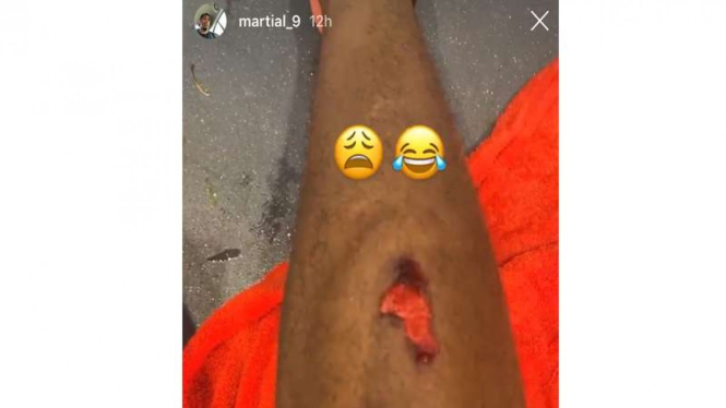 Kondisi tulang kering Anthony Martial usai MU vs ManCity