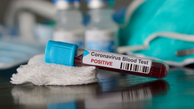Ilustrasi hasil tes darah positif Virus Corona COVID-19