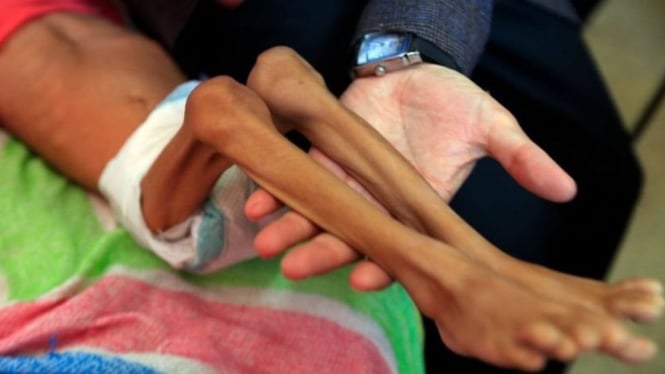 Tim Kesehatan mengatakan jumlah kematian terkait faktor yang berhubungan dengan makanan di Yaman mengalami peningkatan.-MOHAMMED HUWAIS/AFP



