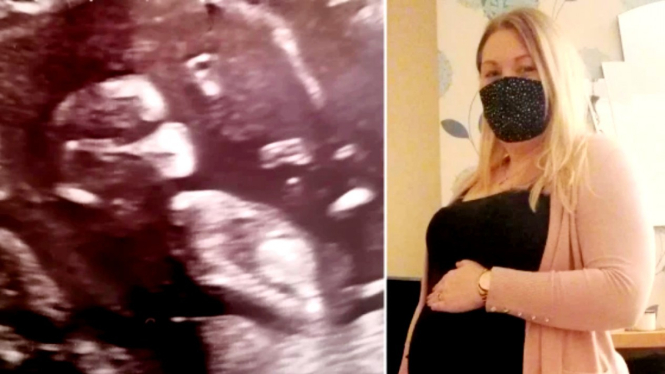 Foto USG kehamilan dengan janin bayi sepeti memakai masker