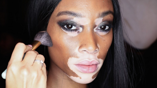 Vitiligo