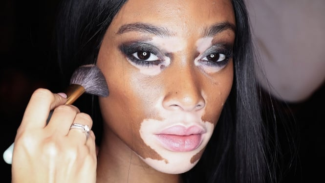 Obat vitiligo menurut al quran