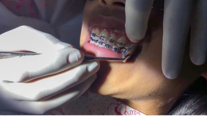 Perawatan kawat gigi oleh dokter gigi profesional. (TSD)