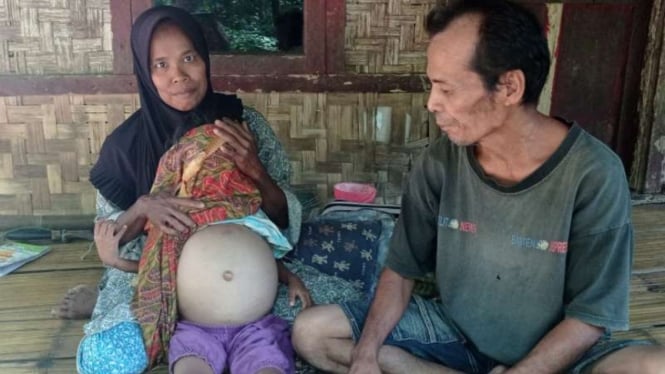 Uniyah, seorang anak berusia delapan tahun, terlihat perutnya membesar karena menderita gizi buruk, saat diperlihatkan oleh ibu dan ayahnya, warga Kabupaten Lebak, Banten, Sabtu, Jumat, 13 Agustus 2021.