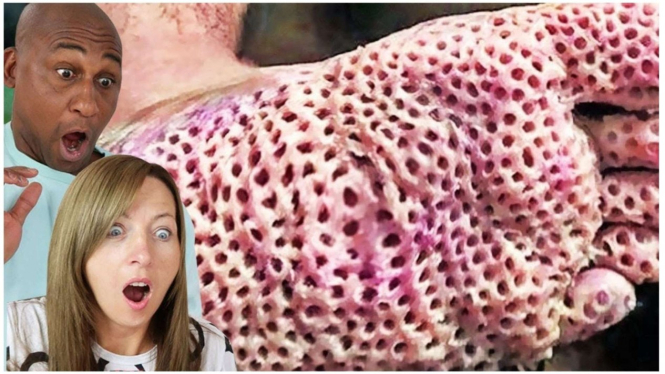 Trypophobia