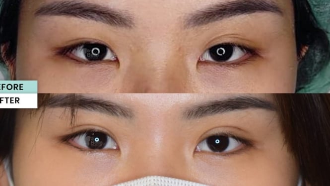 Apa itu double eyelid new arrivals