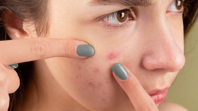 Tak Perlu ke Dokter! Ini 5 Acne Spot Terbaik yang Terbukti Ampuh Mengeringkan Jerawat dalam Waktu Singkat