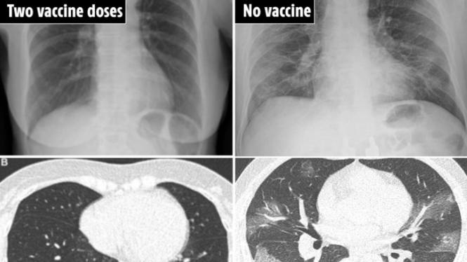 Perbedaan Paru-paru, Setelah dan Sebelum Divaksin COVID-19