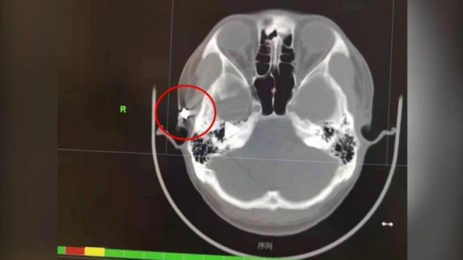 Foto MRI kepala Xiao Chen, yang menunjukkan ada peluru di dalam kepalanya.