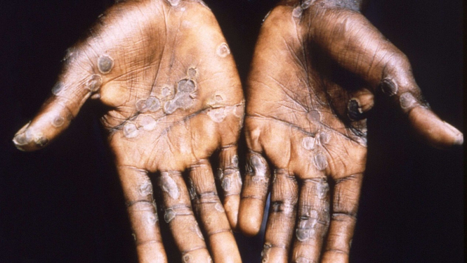 Canada confirms first two cases of monkeypox