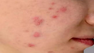 Catat, Ini 6 Fakta Penemuan Kasus Pertama Cacar Monyet di RI