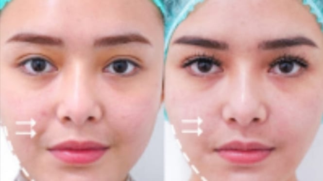 Amanda Manopo lakukan treatment kecantikan. 