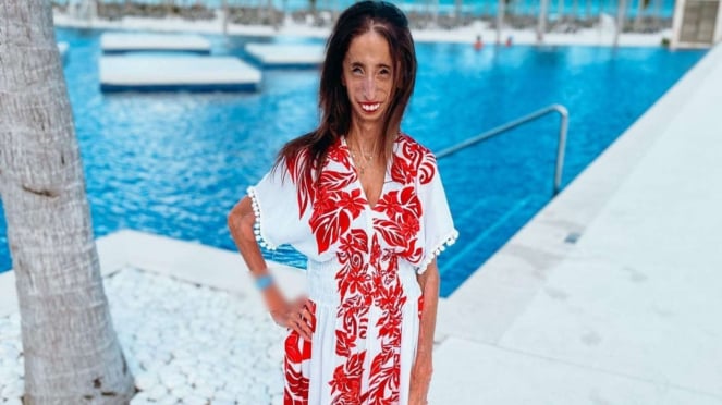 Lizzie Velasquez Bikini