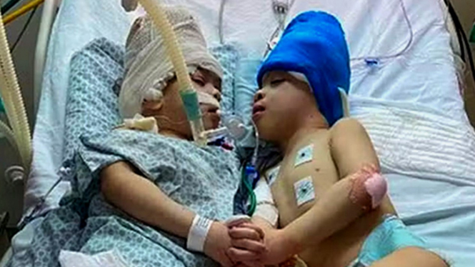 Kondisi pasca operasi bayi kembar di Brasil yang terpaut di bagian kepala