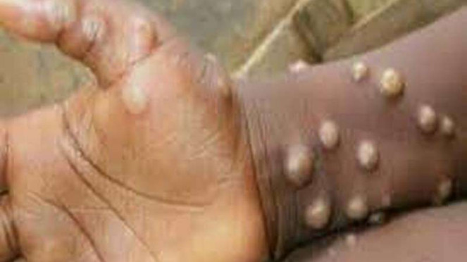 Monkeypox atau cacar monyet