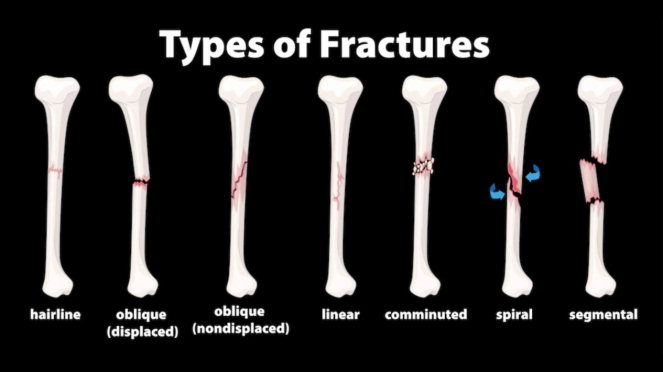 Osteoporosis