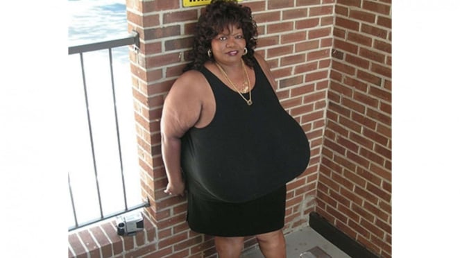 Así es la mujer con el pecho más grande del mundo con un peso de 60 kg