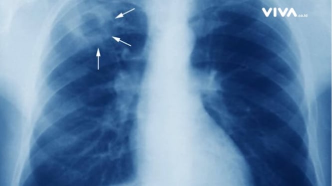 Hasil pemeriksaan rontgen paru-paru terdapat tuberkulosis