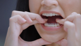 Clear Aligner, Metode Rapikan Gigi yang Diklaim Jauh Lebih Baik dari Behel