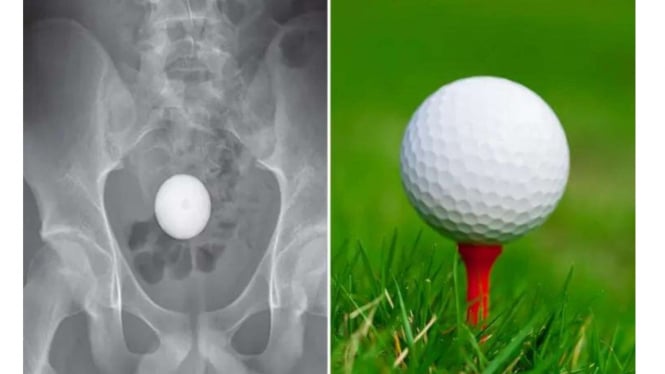 Bola Golf yang masuk kedalam anus dan usus bocah berusia 14 tahun