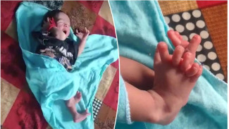 Bayi di India Lahir dengan 26 Jari, Disebut Reinkarnasi Dewi Hindu