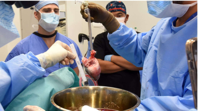 Operasi transpalantasi jantung babi ke manusia.